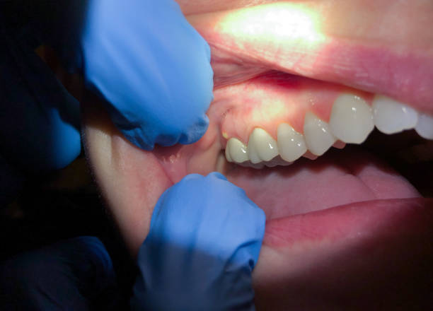 Best Emergency Dental Extractions in Follansbee, WV